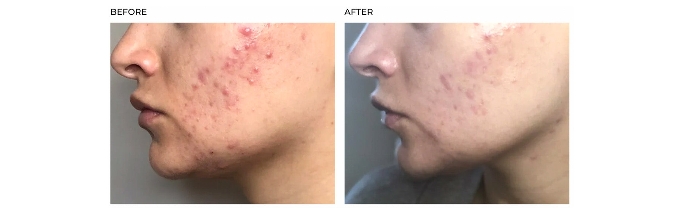 SkinCapsule Clear+ acne results acne before & after