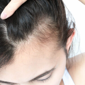 What Is Trichotillomania and How Can You Manage It?
