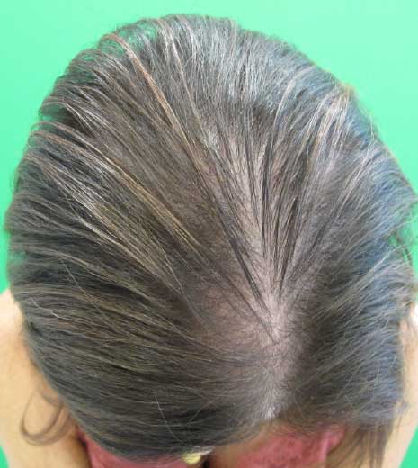hair growth DeeplyRooted results before