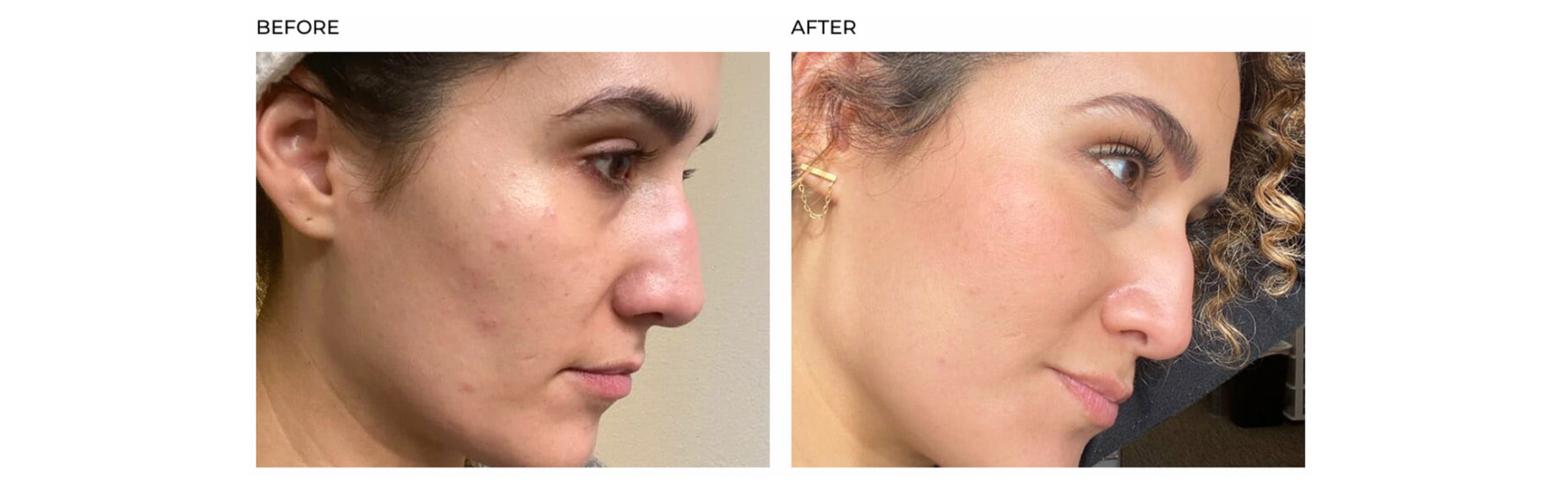 SkinCapsule Clear+ acne results acne before & after 2