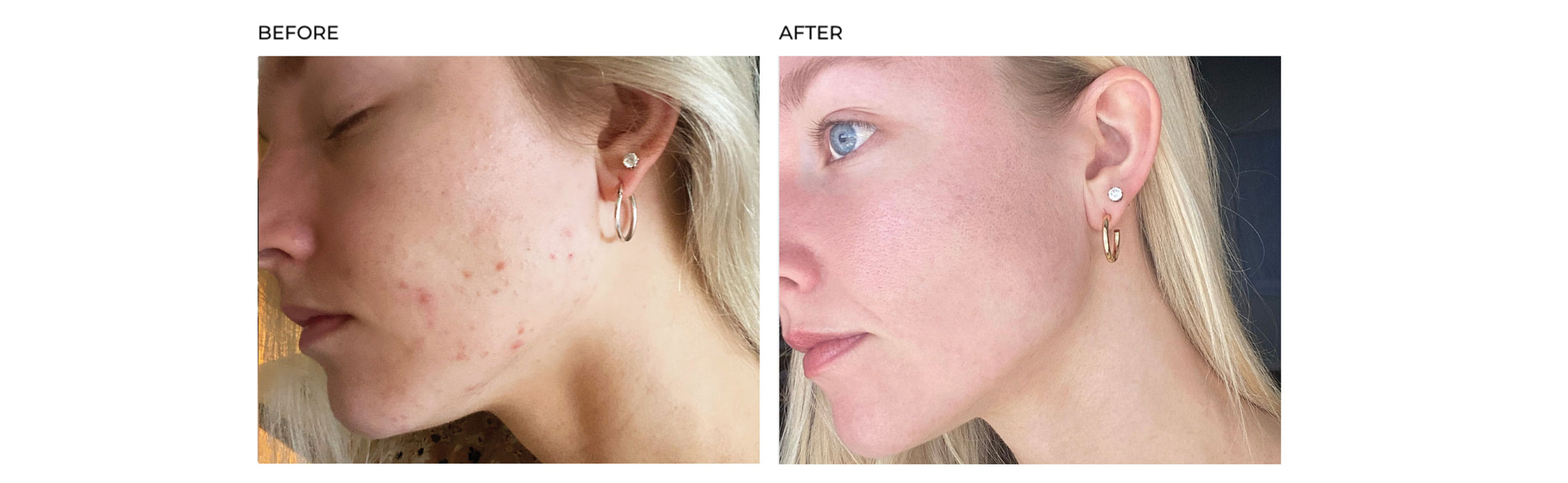 SkinCapsule CLEAR+ Promotes Clear, Blemish-Free Skin, Vitamin A & Zinc ...